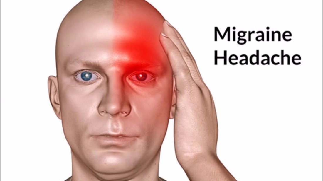 Melegakan Kesakitan Migrain Dengan Minyak Bidara – Herba 